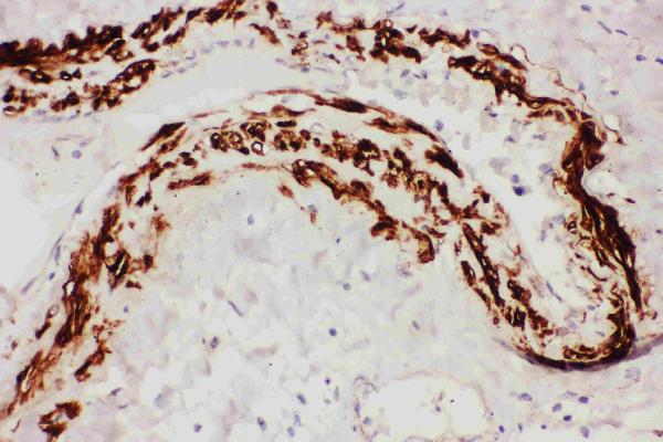 Anti-TFPI antibody, PA1798, IHC(P) IHC(P): Human Lung Cancer Tissue