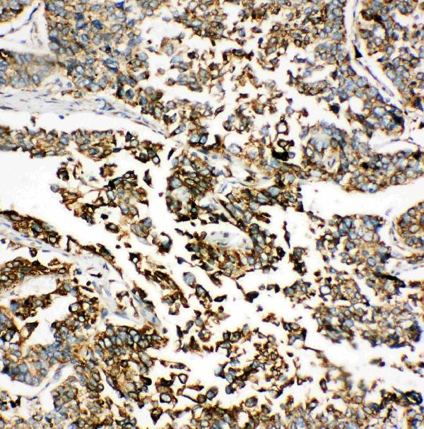 Anti-GRP78 BiP antibody, PA1815, IHC(P) IHC(P): Human Lung Cancer Tissue