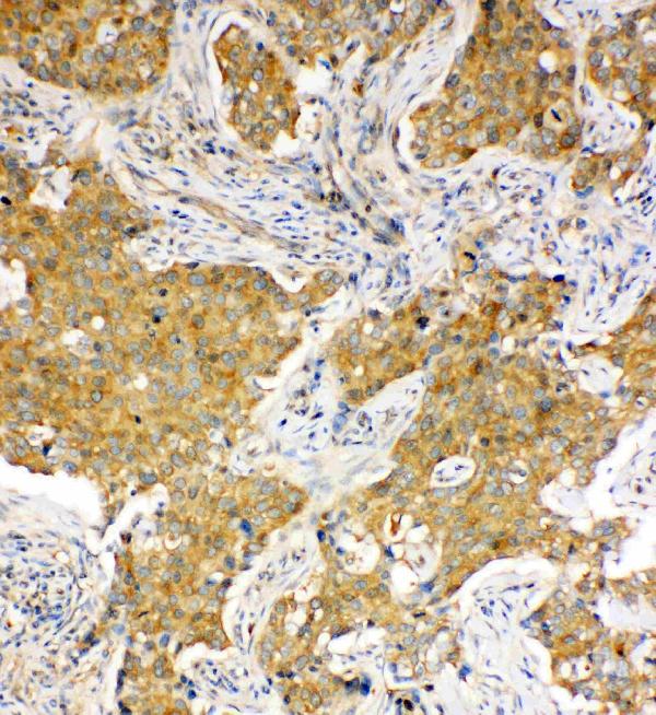 IHC analysis of Hsc70 using anti-Hsc70 antibody (PA1816). Hsc70 was detected in paraffin-embedded section of Human Lung Cancer tissues. Heat mediated antigen retrieval was performed in citrate buffer (pH6, epitope retrieval solution) for 20 mins. The tissue section was blocked with 10% goat serum. The tissue section was then incubated with 1μg/ml rabbit anti-Hsc70 Antibody (PA1816) overnight at 4°C. Biotinylated goat anti-rabbit IgG was used as secondary antibody and incubated for 30 minutes at 37°C. The tissue section was developed using Strepavidin-Biotin-Complex (SABC)(Catalog # SA1022) with DAB as the chromogen.