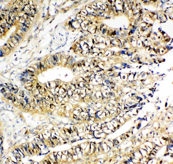 Anti-NME2 antibody, PA1830, IHC(P) IHC(P): Human Intestinal Cancer Tissue