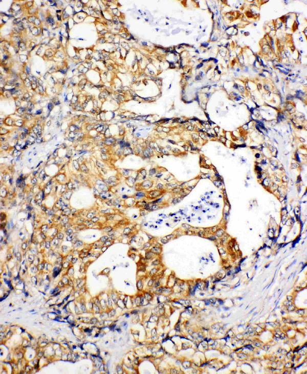 Anti-SDHC antibody, PA1839, IHC(P) IHC(P): Human Gastric Cancer Tissue