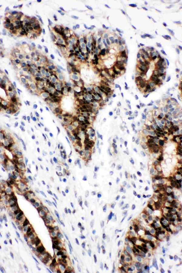 Anti-STAT5b antibody, PA1841, IHC(P) IHC(P): Human Mammary Cancer Tissue