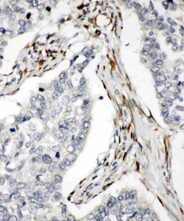 Anti-DR5 antibody, PA1842, IHC(P) IHC(P): Human Lung Cancer Tissue