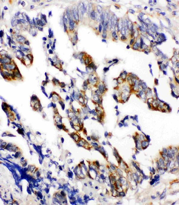 Anti-Beta Arrestin 2 antibody, PA1845, IHC(P) IHC(P): Human Intestinal Cancer Tissue