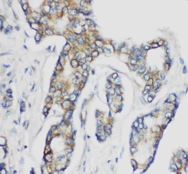 Anti-CD1d antibody, PA1850, IHC(P) IHC(P): Human Mammary Cancer Tissue