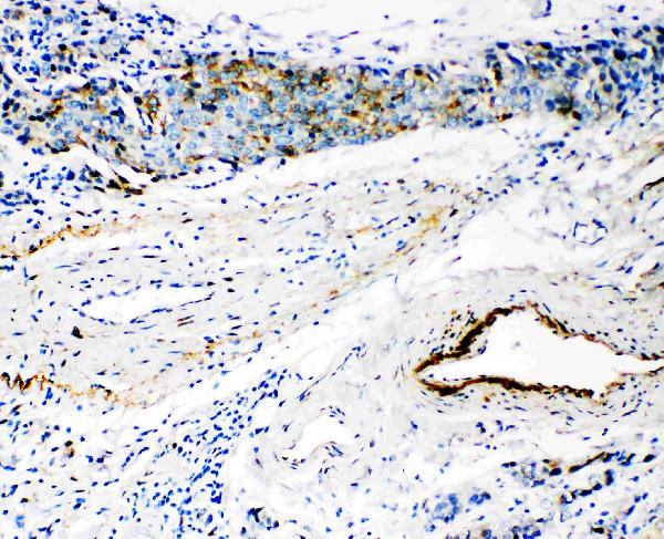 Anti-HYAL3 antibody, PA1856, IHC(P) IHC(P): Human Mammary Cancer Tissue