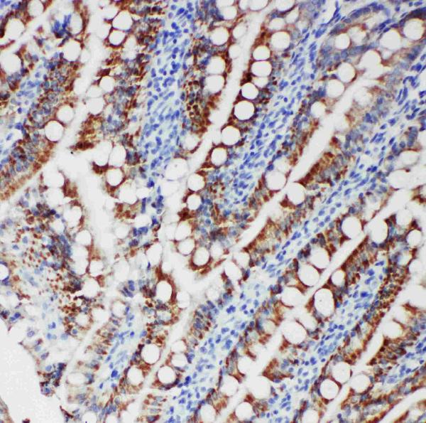 Anti-FER antibody, PA1882, IHC(P) IHC(P): Human Intestinal Cancer Tissue