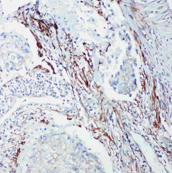 Anti-SHC antibody, PA1897, IHC(P) IHC(P): Human Lung Cancer Tissue