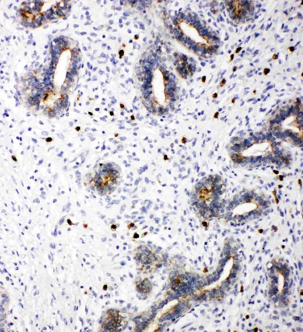 Anti-TRIF antibody, PA1902, IHC(P) IHC(P): Human Mammary Cancer Tissue