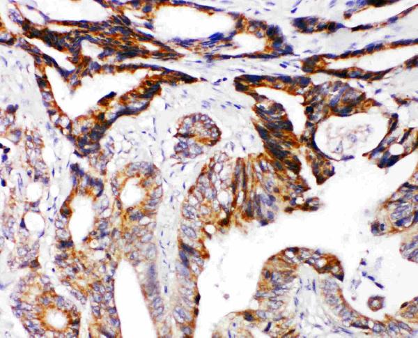 Anti-DCC antibody, PA1910, IHC(P) IHC(P): Human Intestinal Cancer Tissue