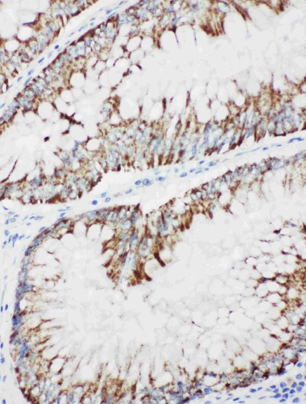 Anti-MEKK1 antibody, PA1923, IHC(P) IHC(P): Human Intestinal Cancer Tissue