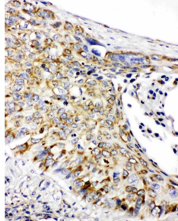 Anti-Prohibitin antibody, PA1932, IHC(P) IHC(P): Human Lung Cancer Tissue