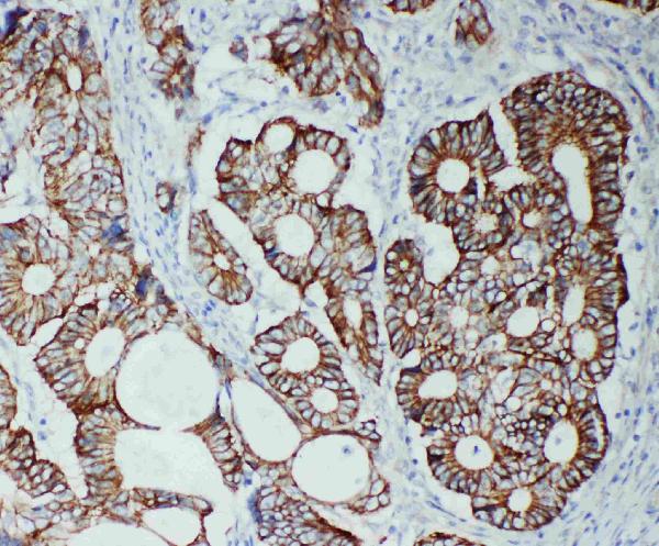 Anti-TJP2 antibody, PA1957, IHC(P) IHC(P): Human Intestinal Cancer Tissue