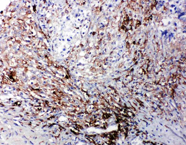 Anti-LTBR antibody, PA1968, IHC(P) IHC(P): Human Intestinal Cancer Tissue