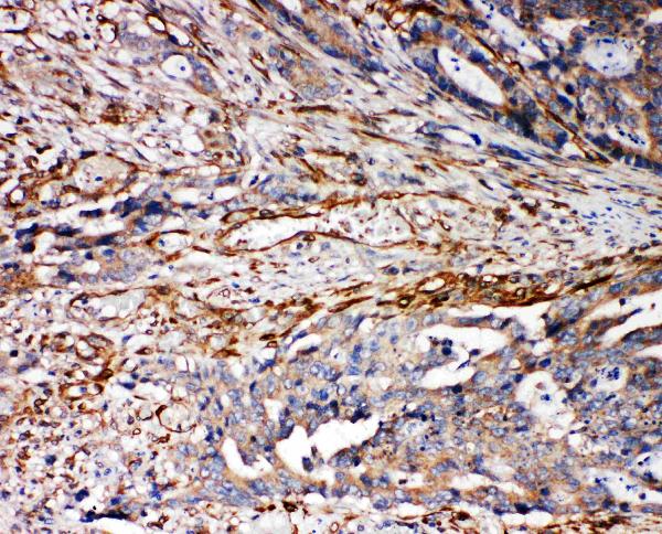 Anti-VRL1 antibody, PA1977, IHC(P) IHC(P): Human Mammary Cancer Tissue