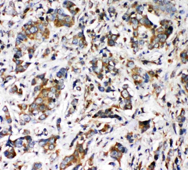 Anti-VRL1 antibody, PA1977, IHC(P) IHC(P): Human Intestinal Cancer Tissue