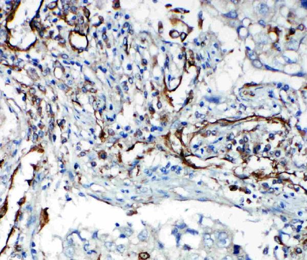 Anti-VEGF Receptor 2 antibody, PA1989, IHC(P) IHC(P): Human Lung Cancer Tissue