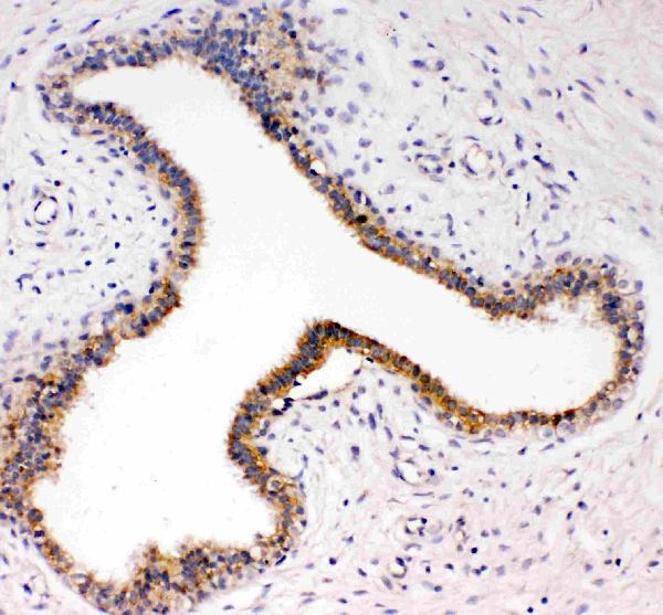 Anti-TrkC antibody, PA1992-1, IHC(P) IHC(P): Human Mammary Cancer Tissue