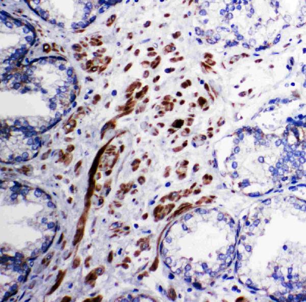 Anti-Mitochondrial Pyruvate dehydrogenase kinase 1 antibody, PA1993, IHC(P) IHC(P): Human Prostatic Cancer Tissue