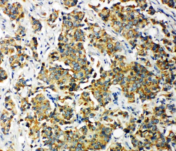 Anti-PDK2 antibody, PA1994, IHC(P) IHC(P): Human Mammary Cancer Tissue