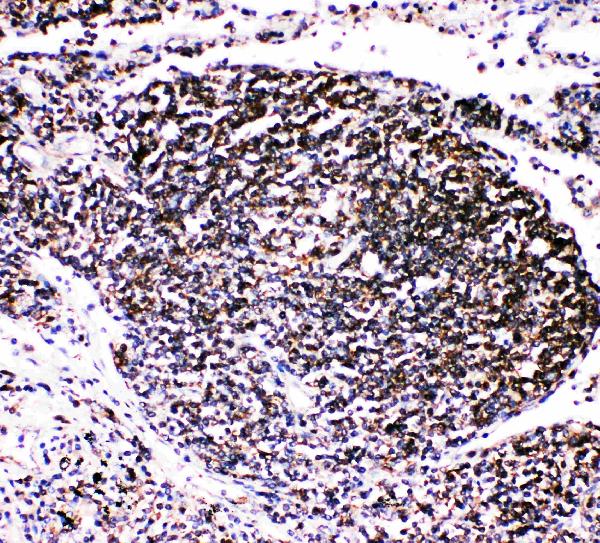 Anti-TRAF4 antibody, PA2009, IHC(P) IHC(P): Human Lung Cancer Tissue