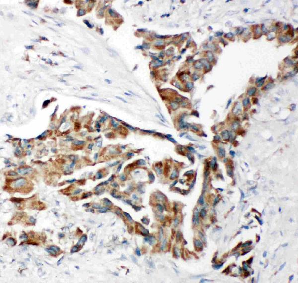 Anti-TRAM1 antibody, PA2010, IHC(P) IHC(P): Human Lung Cancer Tissue