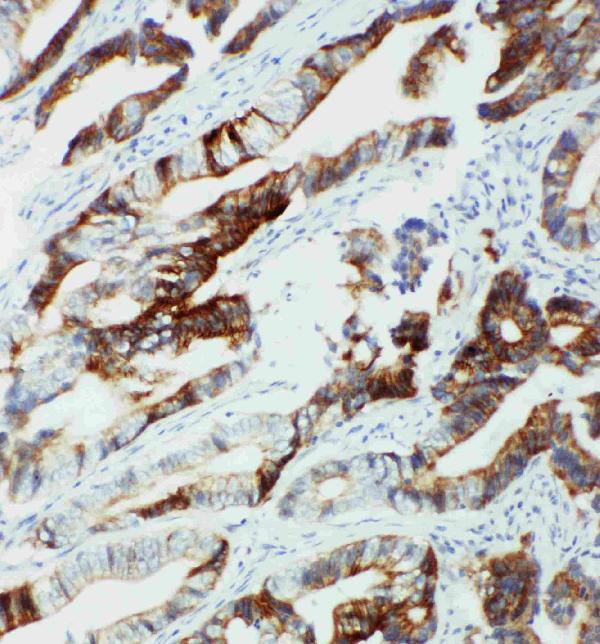 Anti-CYP2U1 antibody, PA2022, IHC(P) IHC(P): Human Intestinal Cancer Tissue