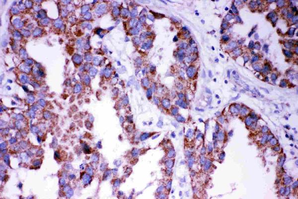 IHC analysis of DISC1using anti-DISC1 antibody (PA2023-1). DISC1 was detected in paraffin-embedded section of human lung cancer tissues. Heat mediated antigen retrieval was performed in citrate buffer (pH6, epitope retrieval solution) for 20 mins. The tissue section was blocked with 10% goat serum. The tissue section was then incubated with 1μg/ml rabbit anti-DISC1 Antibody (PA2023-1) overnight at 4°C. Biotinylated goat anti-rabbit IgG was used as secondary antibody and incubated for 30 minutes at 37°C. The tissue section was developed using Strepavidin-Biotin-Complex (SABC)(Catalog # SA1022) with DAB as the chromogen.