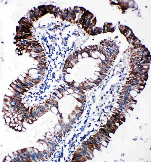 Anti-EIF2S1 antibody, PA2029, IHC(P) IHC(P): Human Intestinal Cancer Tissue