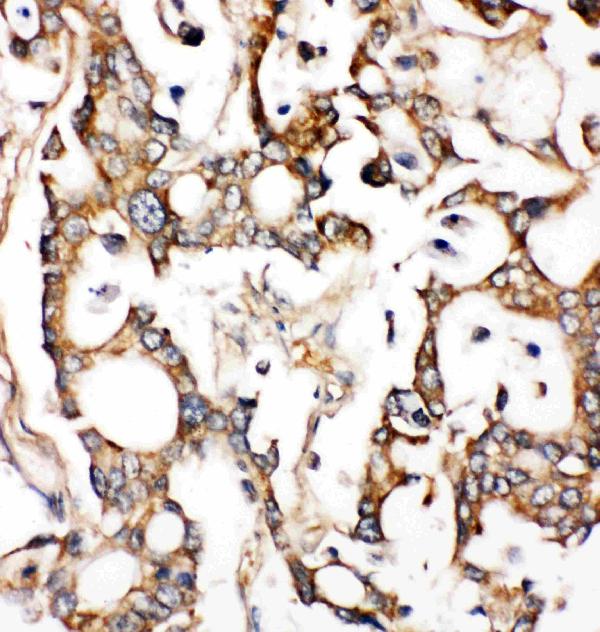 Anti-ALDH2 antibody, PA2073, IHC(P) IHC(P): Human Liver Cancer Tissue