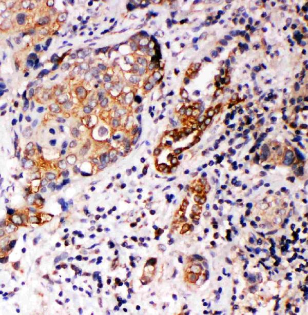 Anti-Annexin A10 antibody, PA2077, IHC(P) IHC(P): Human Lung Cancer Tissue