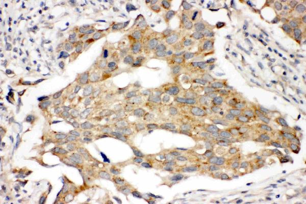 Anti-PRLR antibody, PA2087, IHC(P) IHC(P): Human Mammary Cancer Tissue