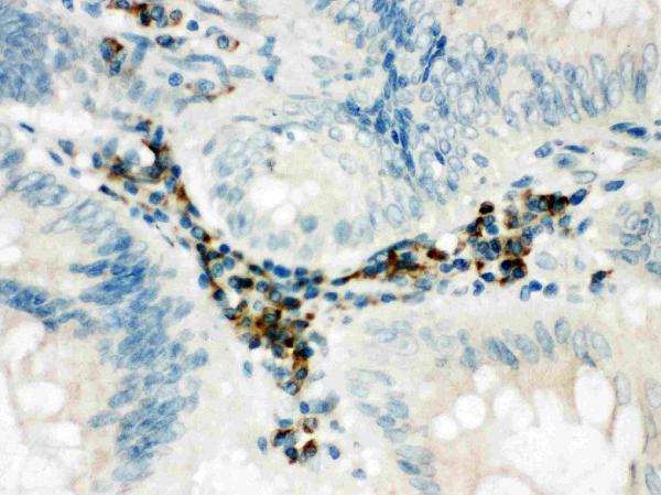 Anti-SPARCL1 antibody, PA2088, IHC(P) IHC(P): Human Intestinal Cancer Tissue