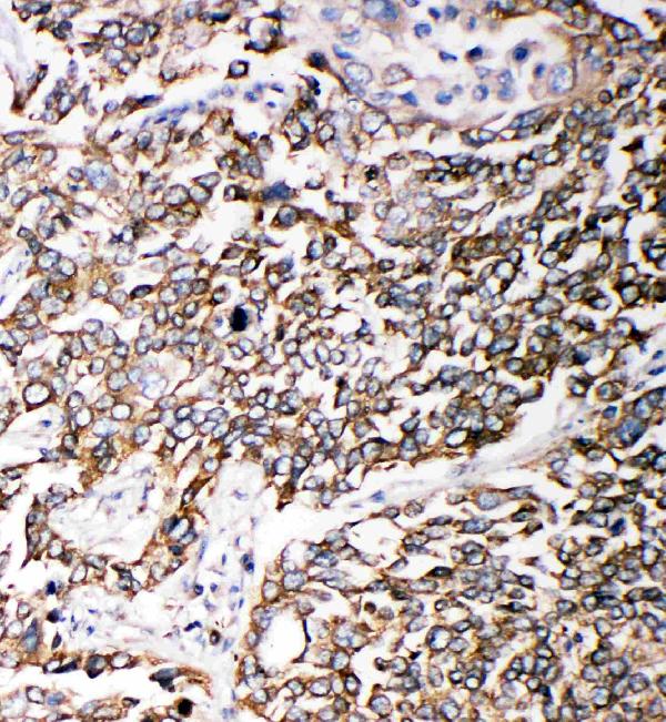 Anti-PMP70 antibody, PA2091, IHC(P) IHC(P): Human Lung Cancer Tissue