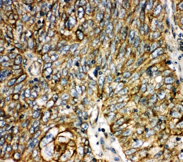 Anti-Aquaporin 6 antibody, PA2092, IHC(P) IHC(P): Human Lung Cancer Tissue