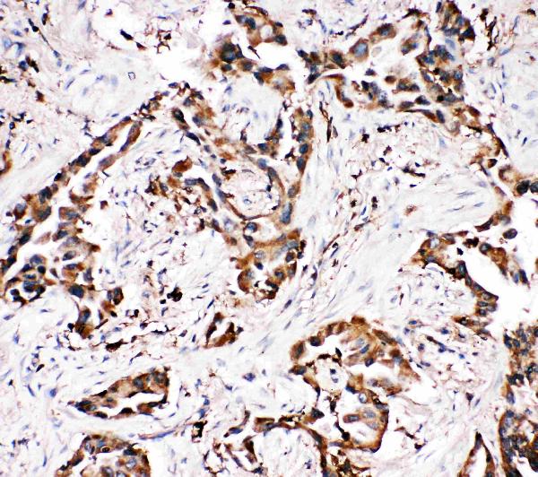 Anti-APLP1 antibody, PA2096, IHC(P) IHC(P): Human Lung Cancer Tissue