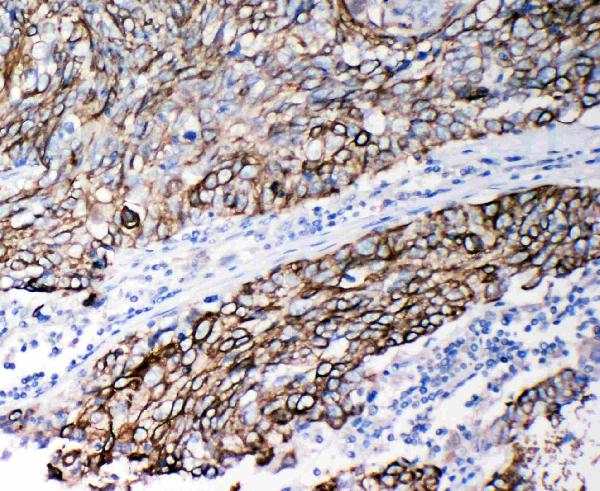 Anti-Stefin B antibody, PA2106, IHC(P) IHC(P): Human Lung Cancer Tissue