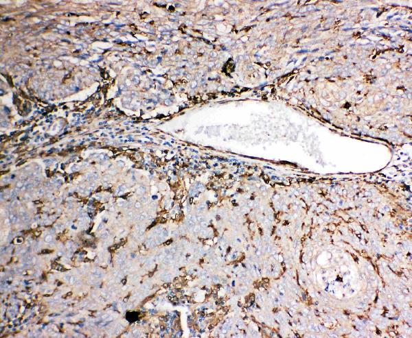 IHC analysis of Gelsolin/GSN using anti-Gelsolin/GSN antibody (PA2109). Gelsolin/GSN was detected in paraffin-embedded section of Human Lung Cancer tissues. Heat mediated antigen retrieval was performed in citrate buffer (pH6, epitope retrieval solution) for 20 mins. The tissue section was blocked with 10% goat serum. The tissue section was then incubated with 1μg/ml rabbit anti-Gelsolin/GSN Antibody (PA2109) overnight at 4°C. Biotinylated goat anti-rabbit IgG was used as secondary antibody and incubated for 30 minutes at 37°C. The tissue section was developed using Strepavidin-Biotin-Complex (SABC)(Catalog # SA1022) with DAB as the chromogen.