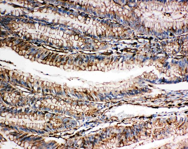 IHC analysis of Gelsolin/GSN using anti-Gelsolin/GSN antibody (PA2109). Gelsolin/GSN was detected in paraffin-embedded section of Human Intestinal Cancer tissues. Heat mediated antigen retrieval was performed in citrate buffer (pH6, epitope retrieval solution) for 20 mins. The tissue section was blocked with 10% goat serum. The tissue section was then incubated with 1μg/ml rabbit anti-Gelsolin/GSN Antibody (PA2109) overnight at 4°C. Biotinylated goat anti-rabbit IgG was used as secondary antibody and incubated for 30 minutes at 37°C. The tissue section was developed using Strepavidin-Biotin-Complex (SABC)(Catalog # SA1022) with DAB as the chromogen.