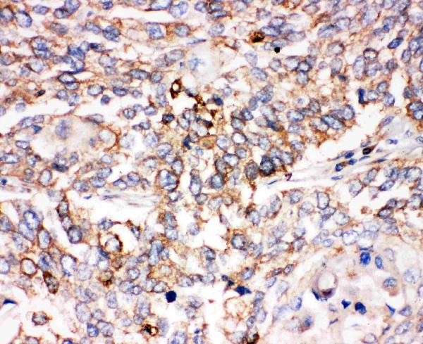 Anti-Smad1 antibody, PA2114, IHC(P) IHC(P): Human Lung Cancer Tissue