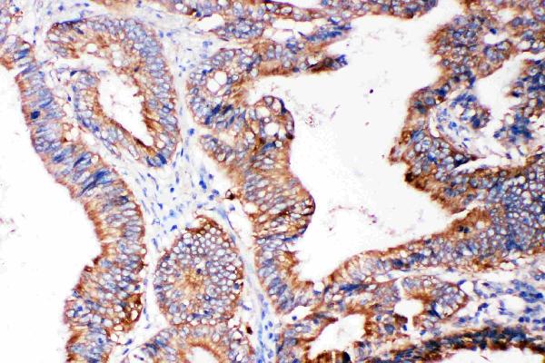 Anti-SMAD5 antibody, PA2115, IHC(P) IHC(P): Human Intestinal Cancer Tissue