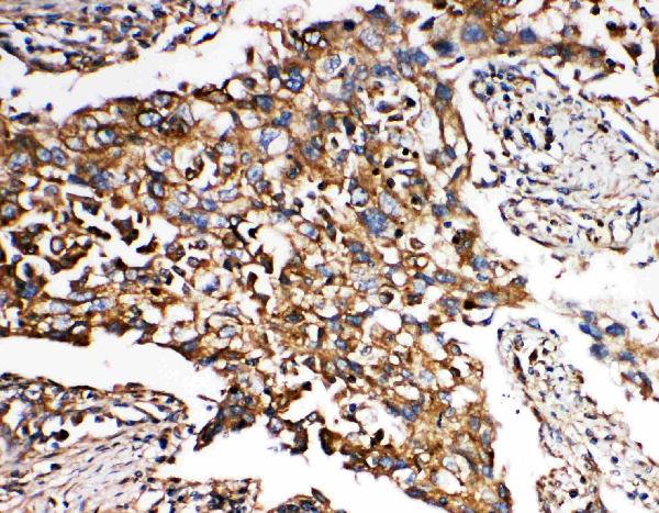 Anti-SMAD5 antibody, PA2115, IHC(P) IHC(P): Human Lung Cancer Tissue