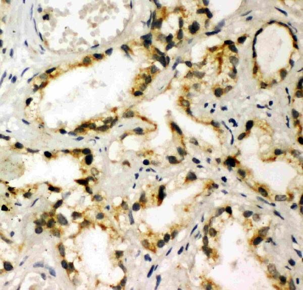 Anti-NAK antibody, PA2117, IHC(P) IHC(P): Human Prostatic Cancer Tissue