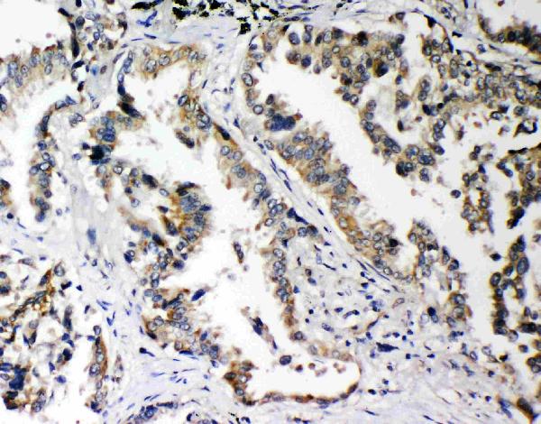 IHC analysis of PLK2/Snk using anti-PLK2/Snk antibody (PA2131). PLK2/Snk was detected in paraffin-embedded section of human lung cancer tissues. Heat mediated antigen retrieval was performed in citrate buffer (pH6, epitope retrieval solution) for 20 mins. The tissue section was blocked with 10% goat serum. The tissue section was then incubated with 1μg/ml rabbit anti-PLK2/Snk Antibody (PA2131) overnight at 4°C. Biotinylated goat anti-rabbit IgG was used as secondary antibody and incubated for 30 minutes at 37°C. The tissue section was developed using Strepavidin-Biotin-Complex (SABC)(Catalog # SA1022) with DAB as the chromogen.