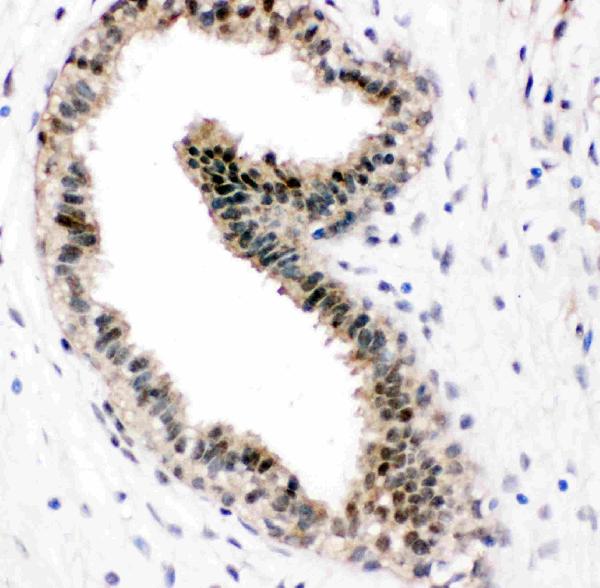 Anti-VCP antibody, PA2137, IHC(P) IHC(P): Human Mammary Cancer Tissue