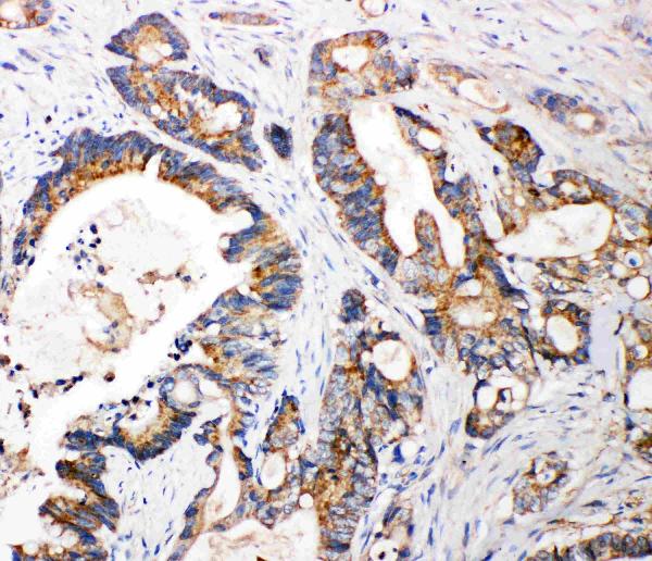 Anti-FGFR3 antibody, PA2143, IHC(P) IHC(P): Human Intestinal Cancer Tissue