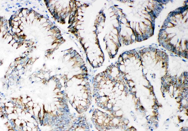 Anti-MMP14 antibody, PA2147, IHC(P) IHC(P): Human Intestinal Cancer Tissue