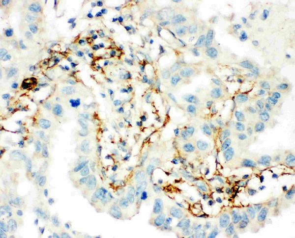 Anti-TGM2 antibody, PA2153, IHC(P) IHC(P): Human Lung Cancer Tissue