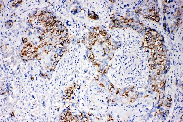 Anti-beta Arrestin 1 antibody, PA2155, IHC(P) IHC(P): Human Mammary Cancer Tissue