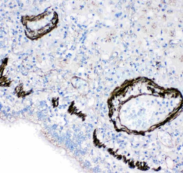 Anti-FABP6 antibody, PA2158, IHC(P) IHC(P): Human Lung Cancer Tissue